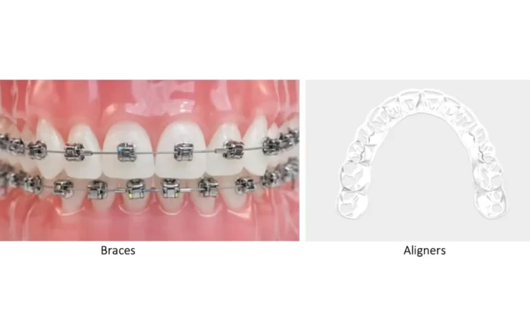 A side by side images showing a mouth with braces and an overhead view of aligners